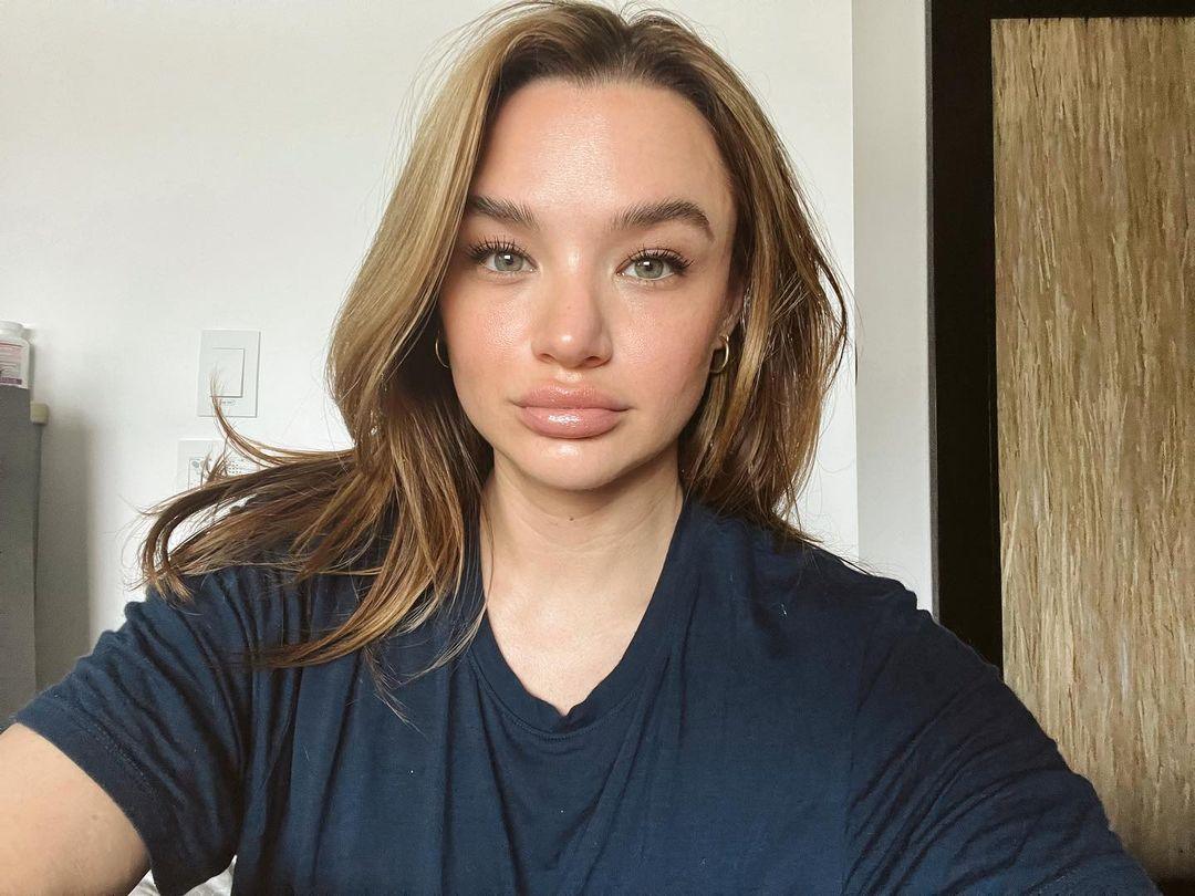 Hunter King accused of getting lip fillers
