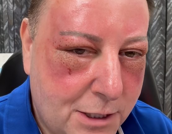 90 Day Fiance Star David Toborowsky Gets A Facial Procedure – Instagram