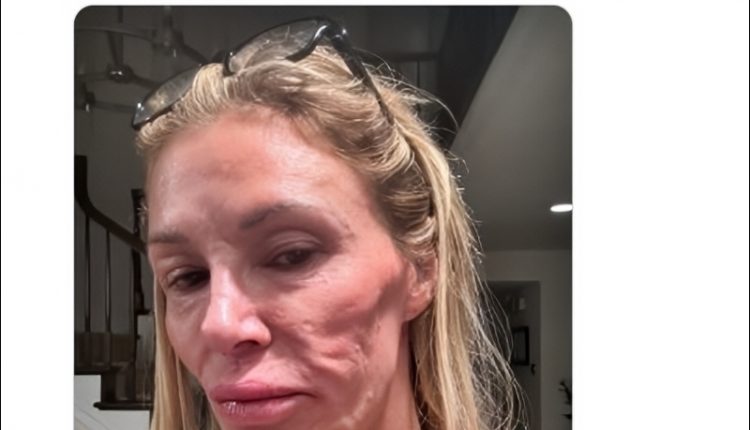 Brandi Glanville Shares Horrifying Facial Changes – X