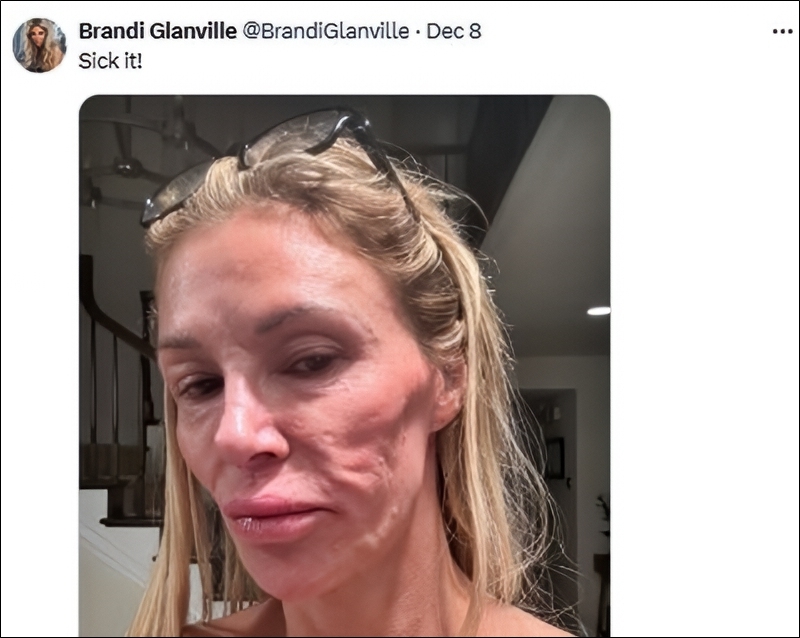 Brandi Glanville Shares Horrifying Facial Changes - X