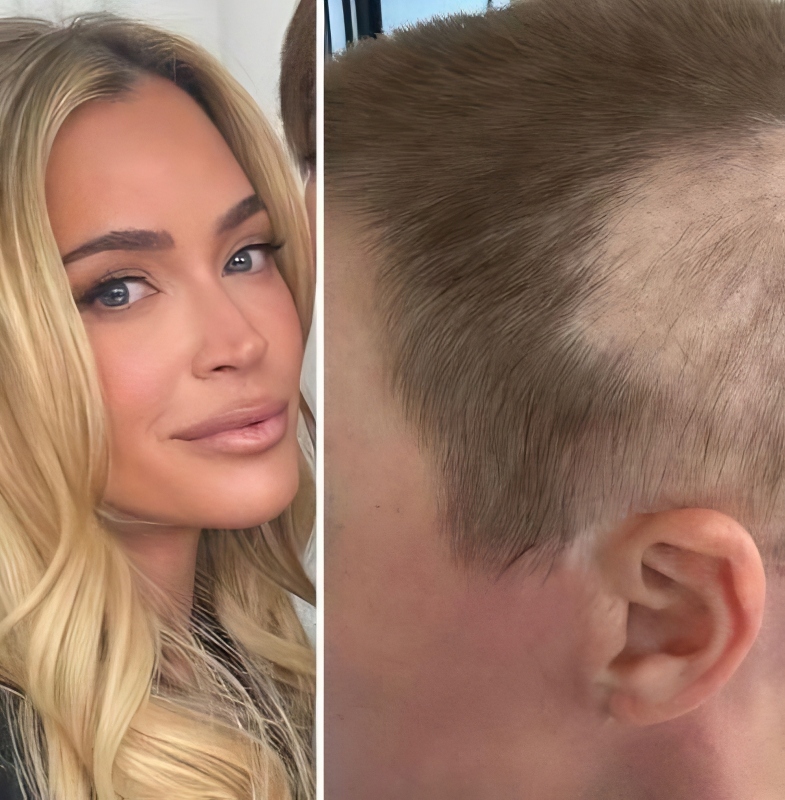 Teddi wears wigs because of baldness on one side - Instagram