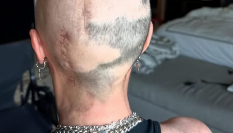 Teddi shares photo that show her scars after brain surgery – Instagram