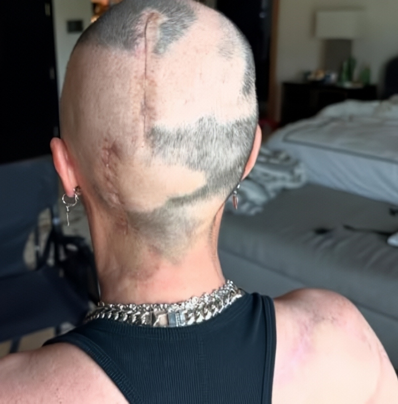 Teddi shares photo that show her scars after brain surgery - Instagram