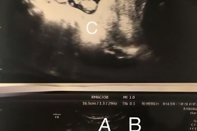 Scan showing Danielle’s babies in her womb – Instagram