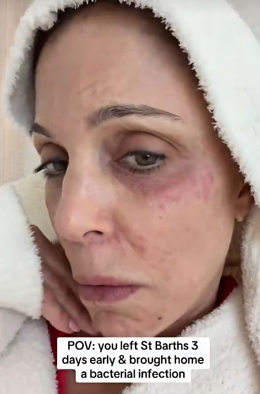 The face infection - @bethenneyfrankel - TikTok